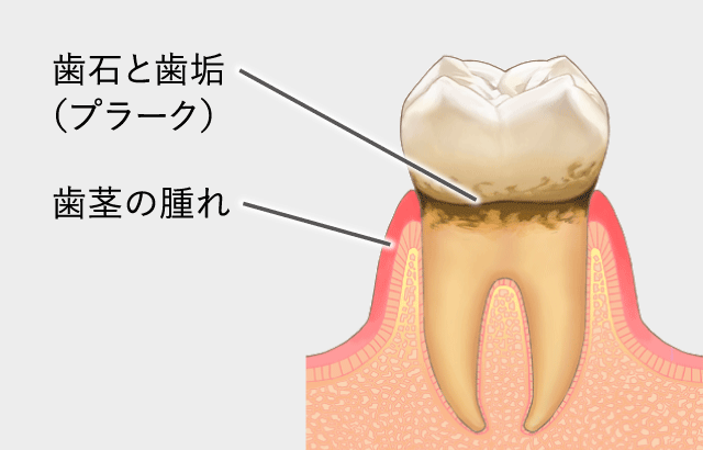 歯肉炎