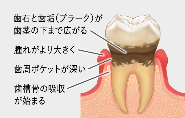 歯周炎（軽度〜中等度）